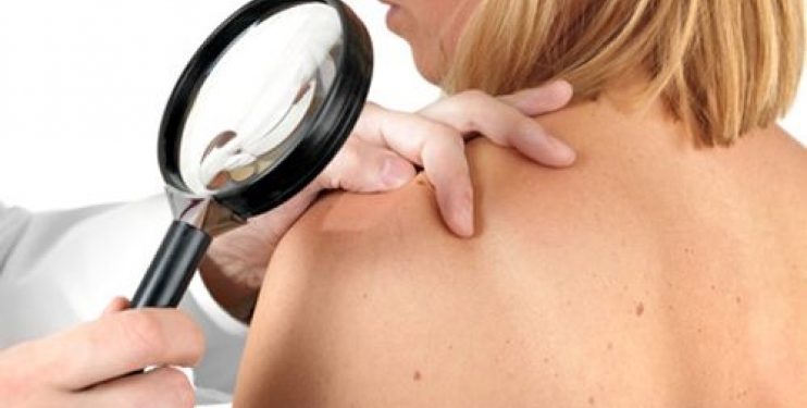 melanoma