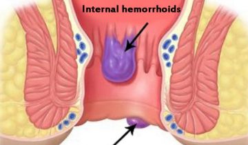 internal-and-external-hemorrhoids