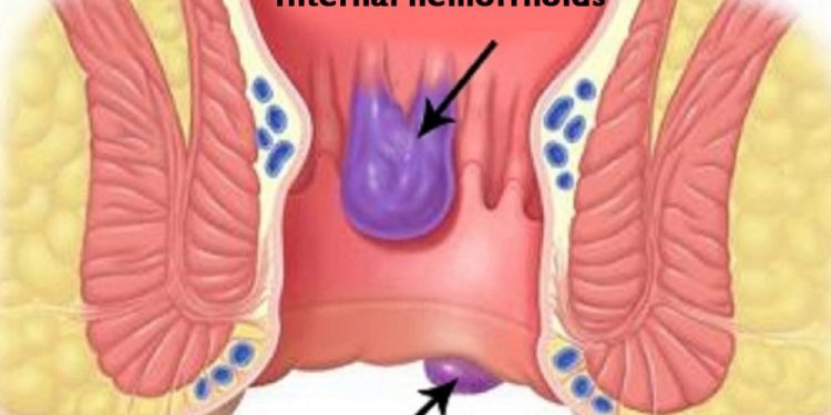 internal-and-external-hemorrhoids