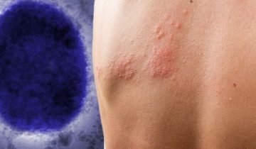 monkeypox-1