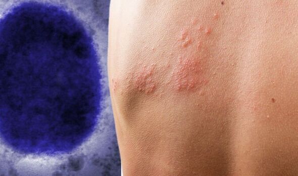 monkeypox-1