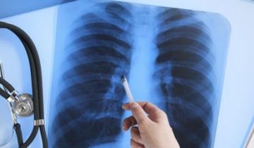 27658821_lung-xray-cancer