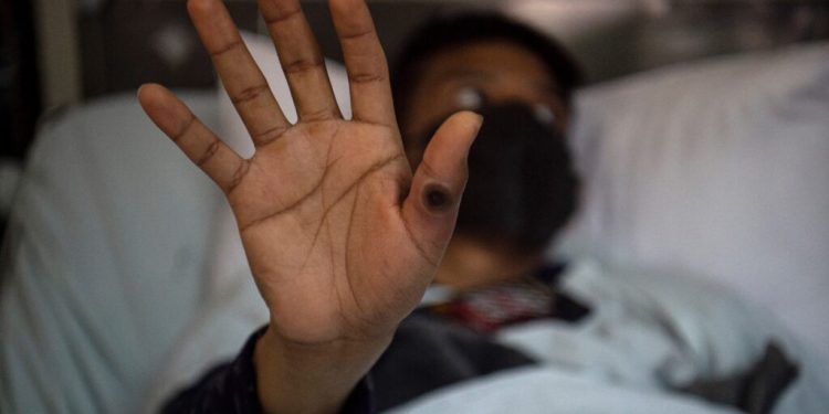 (FILES) This file photo taken on August 16, 2022 shows a patient showing his hand with a sore caused by an infection of the monkeypox virus, in the isolation area for monkeypox patients at the Arzobispo Loayza hospital, in Lima, Peru. Shares of the pharmaceutical laboratories of Bavarian Nordic in Denmark, which manufactures a specific vaccine against the mpox, jumped up on August 15, 2024 following the decision of the World Organization of Health WHO to consider the resurgence of monkeypox cases together with an urgent need for health care in the world. A surging mpox outbreak in Africa, which was declared an emergency by the continent's health agency on August 13, is being driven by a new, more transmissible strain of the virus. The Africa Centres for Disease Control and Prevention (Africa CDC) declared its first-ever Public Health Emergency of Continental Security (PHECS) for the deadly disease. Bavarian Nordic mainly supplies its mpox vaccine - called Jynneos in the US, Imvanex in the European Union - to governments and international organisations but began marketing it on the US market in April. (Photo by Ernesto BENAVIDES / AFP)